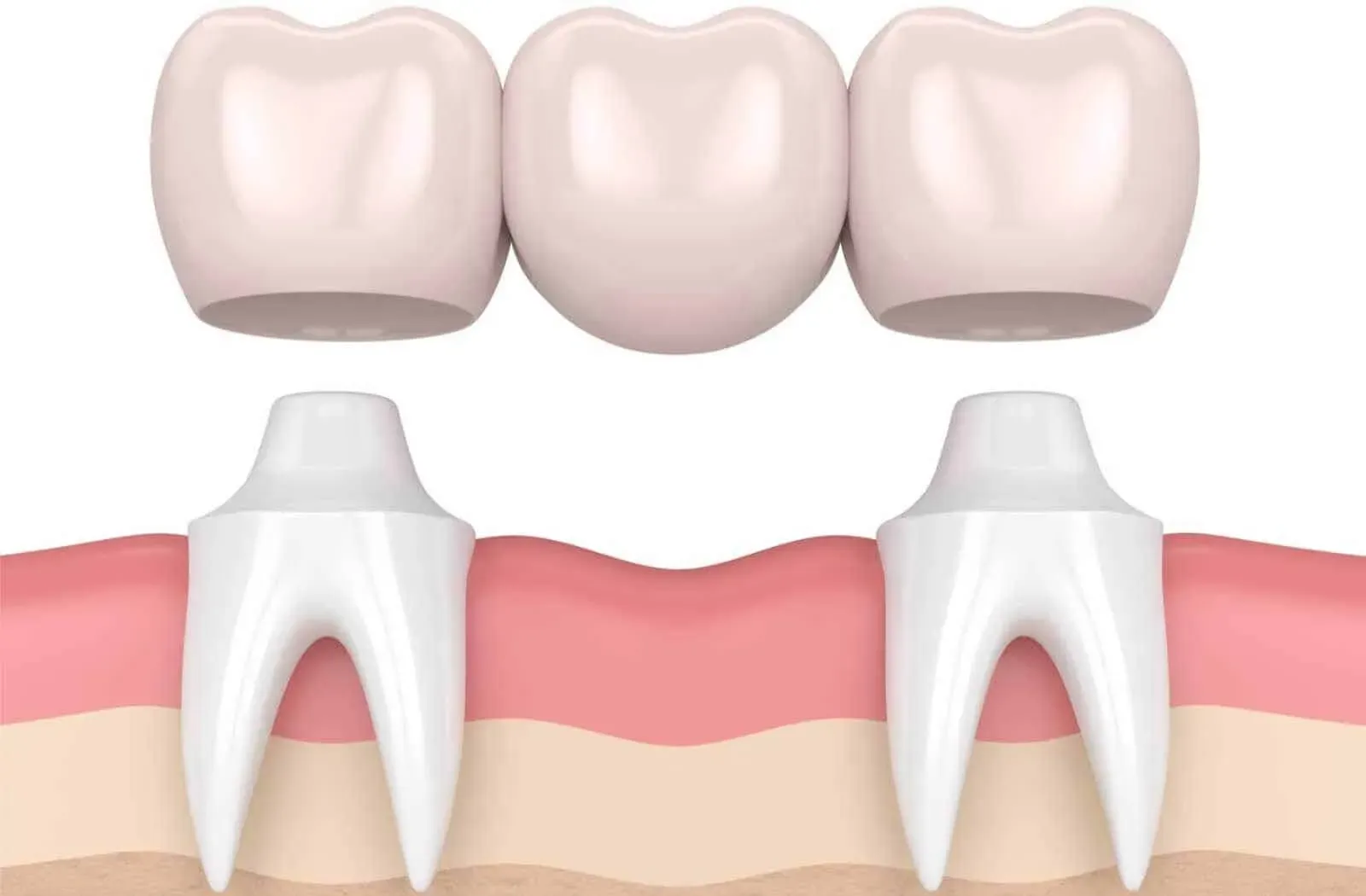Dental Bridge